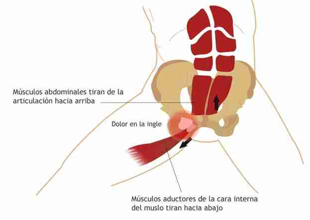 pubalgia en corredores